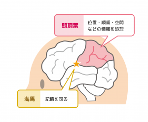 アルツハイマー型認知症