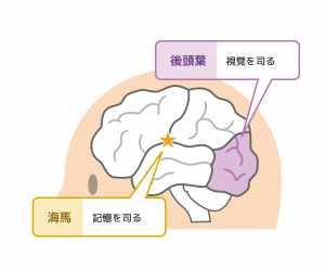 レビー小体型認知症