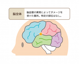 脳血管性認知症